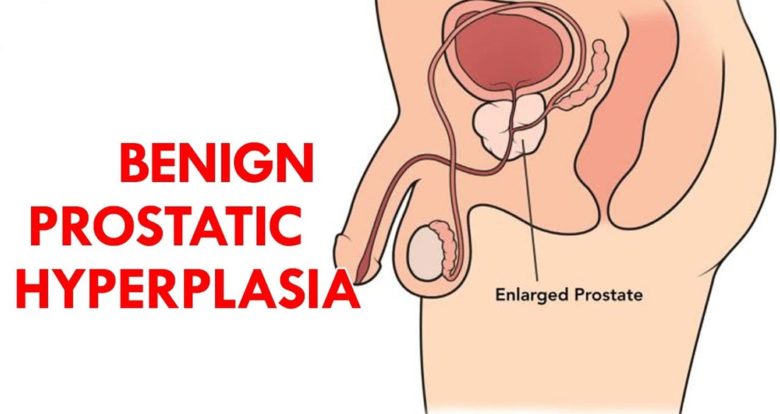 BENIGN PROSTATE ENLARGEMENT