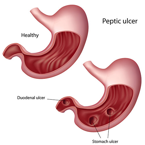 CAUSES OF STOMACH ULCER & PEPTIC ULCER SYMPTOMS