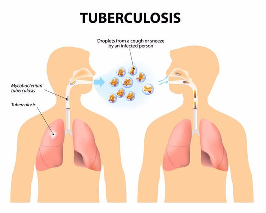 SYMPTOMS OF TUBERCULOSIS
